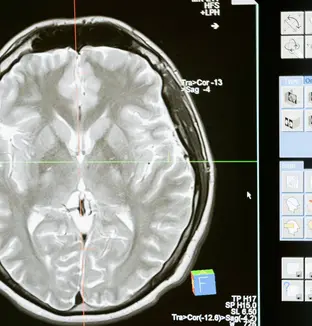IRM du cerveau